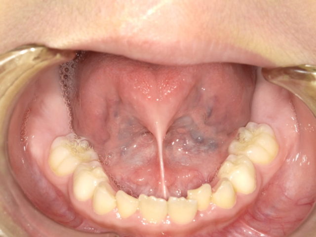 舌小帯のライトタッチレーザーによる低侵襲切除 発音障害の改善 富山市の歯医者 ブナの杜歯科クリニック