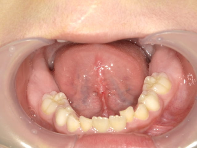 舌小帯のライトタッチレーザーによる低侵襲切除 発音障害の改善 富山市の歯医者 ブナの杜歯科クリニック